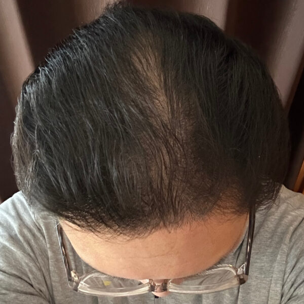 薄毛改善の検証実験開始より9ヶ月経過後　頭頂部状態　画像